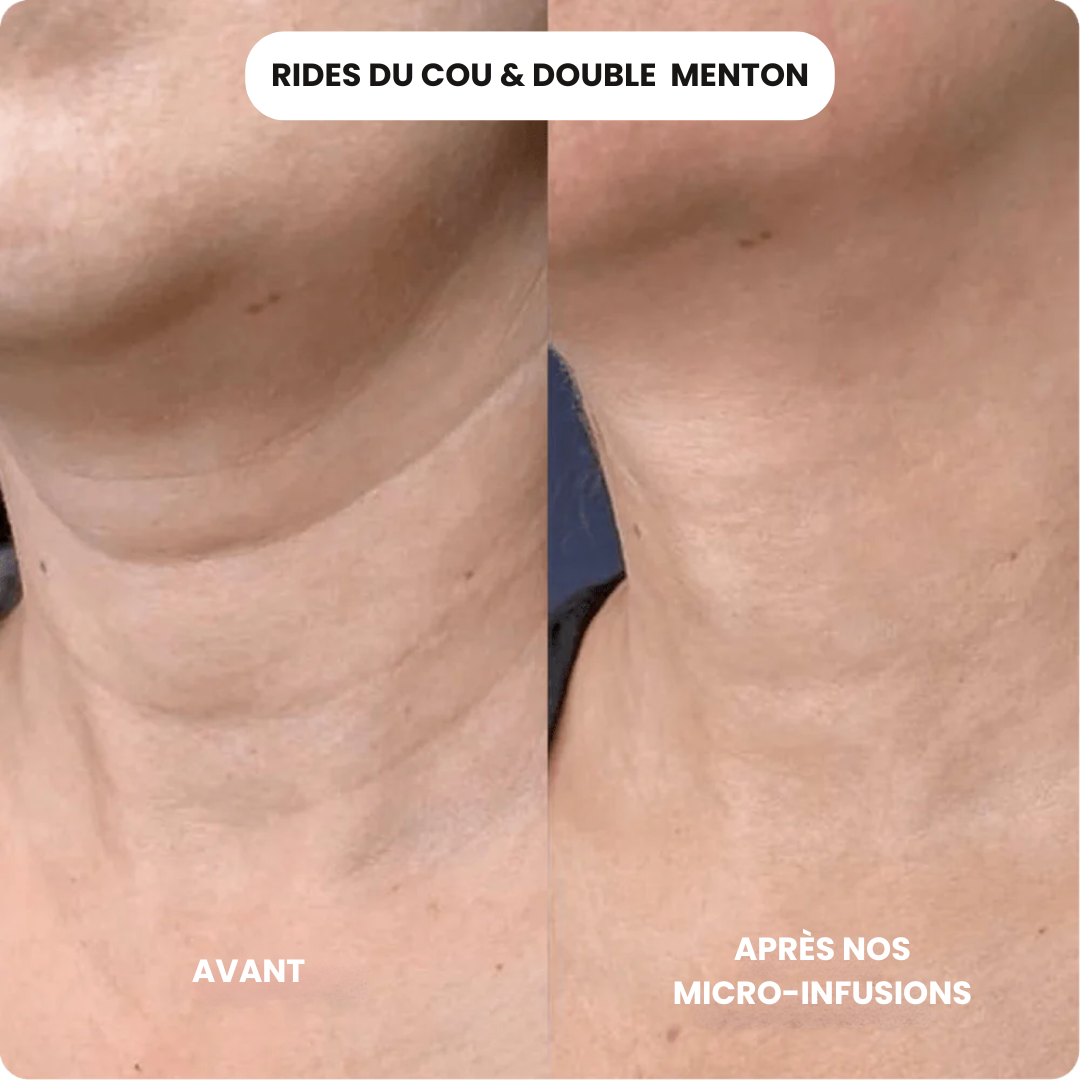 Micro-Infusion Anti-Âge Hairovia®